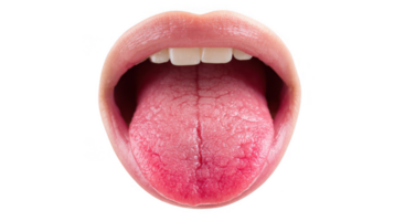 Open mouth showing inflamed tongue with glossitis on transparent background png