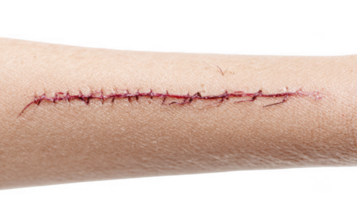 Surgical scar showing stitches on transparent background png