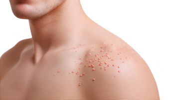 Man showing chickenpox symptoms on shoulder with transparent background png