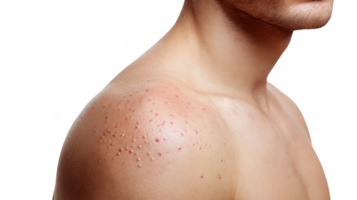 Man showing chickenpox symptoms on shoulder on transparent background png