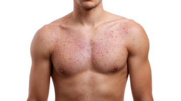 Man showing measles rash on chest and shoulders on transparent background png