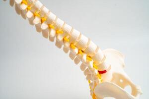 Lumbar spine displaced herniated disc fragment, spinal nerve and bone. Model treatment photo
