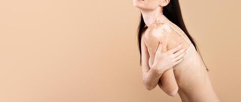 Skin Disorders. Cropped Shot Of Slim Female With Vitiligo Condition Standing In Underwear Over Beige Studio Background, Young Skinny Lady With Lack Of Melanin Posing In Studio, Closeup With Copy Space photo
