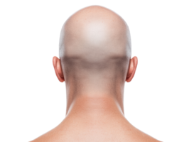 Bald head close-up showing skin texture and scalp health png