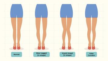 Illustration of Different Womens Leg Shapes Showing Normal and Abnormalities vector