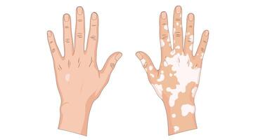 Two hands with white spots on them vector