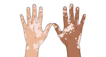 Two hands with spots on them, one with white and one with brown vector
