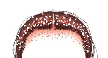 Understanding Dandruff Prevention and Treatment A Guide to Scalp Health and Relief vector