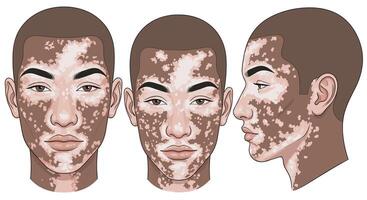 Understanding Vitiligo A Comprehensive Guide to Causes Symptoms and Treatment Options Available vector