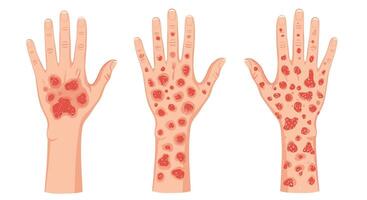 Skin Rash Identification And Diagnosis Understanding Various Types of Skin Rashes on Hand vector