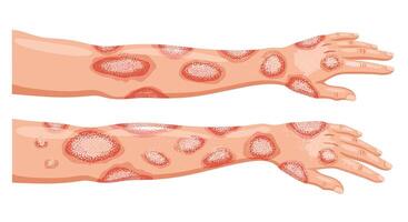 Understanding Skin Rash Conditions Symptoms Causes Diagnosis and Treatment Options A Complete Guide vector