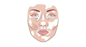 Understanding and Managing Vitiligo A Comprehensive Guide to Skin Health and Treatment vector