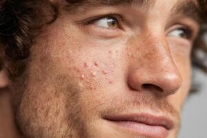 A close up of a man with acne on his face photo