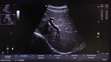 Ultrasound Scan Display on Medical Monitor, Detailed Internal Organ Imaging Scene video