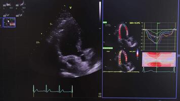 Cardiac Ultrasound Display with ECG, Medical Imaging and Heart Strain Analysis video