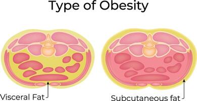 Types of Obesity Science Design Illustraiton Diagram vector