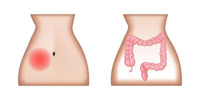Medical illustration showing location of pain in the lower right abdominal quadrant and inflamed appendix, a condition known as appendicitis vector