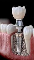 Dental Implant Model Demonstrating Tooth Replacement Process in a Dental Clinic Setting. photo