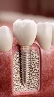Dental Implant Model Demonstrating Tooth Replacement Process in a Dental Clinic Setting photo
