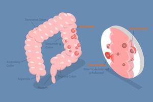 3D Isometric Flat Conceptual Illustration of Diverticulitis, Medical Sructure and Location vector