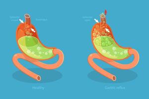 3D Isometric Flat Conceptual Illustration of Stomach Reflux, Digestive System Problems vector