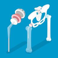 3D Isometric Flat Conceptual Illustration of Total Hip Replacement, Joint Implant vector