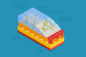 3D Isometric Flat Conceptual Illustration of Peptic Ulcer, Digestive Tract Disorder vector
