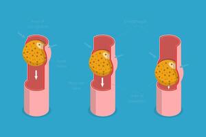 3D Isometric Flat Conceptual Illustration of Peristalsis, Swallow Eating Problem vector