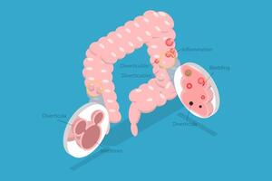 3D Isometric Flat Conceptual Illustration of Diverticulosis And Diverticulitis, Medical Structure and Location vector