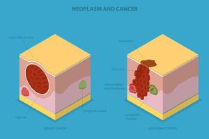 3D Isometric Flat Conceptual Illustration of Neoplasm And Cancer, Tumor Development vector