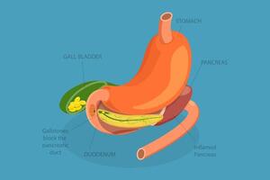 3D Isometric Flat Conceptual Illustration of Acute Pancreatitis, Digestive System Issues vector