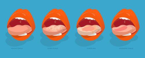 3D Isometric Flat Conceptual Illustration of Sore Or White Tongue, Definition of the Disease by Tongue vector
