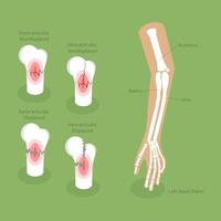 3D Isometric Flat Conceptual Illustration of Distal Radius Fracture, Labeled Educational Diagram vector