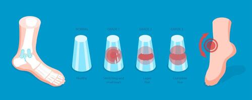 3D Isometric Flat Conceptual Illustration of Grades Of Sprain, Ankle Problem vector