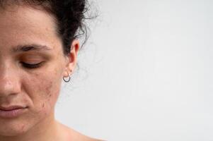 skin texture with red pimples, irritation and clogged pores, which indicates dermatological problems with skin care. Hormonal acne and spots on the face photo