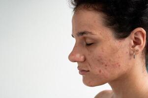 skin texture with red pimples, irritation and clogged pores, which indicates dermatological problems with skin care. Hormonal acne and spots on the face. photo