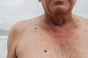 keratinizing squamous cell carcinoma of the skin of an elderly man. photo