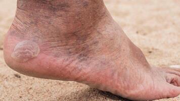 Bare male feet with a callus on the heel and venous dilatation of veins photo