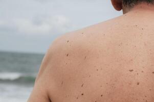 The back of an elderly man with freckles, aging spots, black, brown warts and wrinkles photo