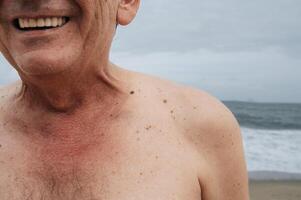 Skin texture black birthmarks and moles on the skin of an elderly man. photo