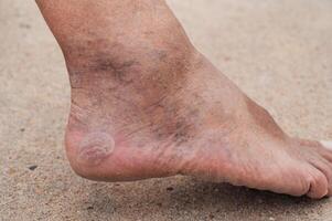 Bare male feet with a large callus on the heel and venous dilatation of veins photo