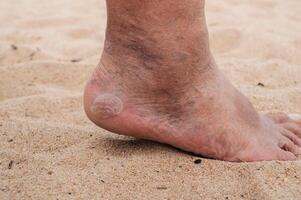 Bare male feet with a large callus on the heel and venous dilatation of veins. photo