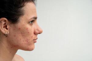 Close-up skin texture with red pimples, irritation and clogged pores, which indicates dermatological problems with skin care. Hormonal acne and spots on the face photo