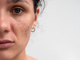 Close-up of a young girl with skin problems. Pimples, acne, pores, scars. Natural skin with and without filters. A place for your text photo