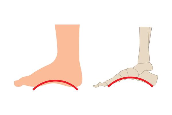 Feet with too high arches, feet with high arches