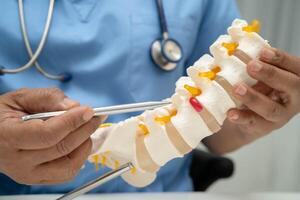 spinal nerve and bone model, Lumbar spine displaced herniated disc photo