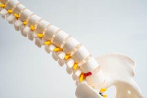 Spinal nerve and bone, Lumbar spine displaced herniated disc fragment, Model for treatment medical in the orthopedic photo