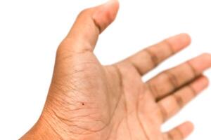 Close-up of a hand with a tiny speck of blood indicating a minor injury or health check photo