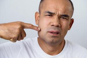 The Man facial swelling due to an allergic reaction to triggers such as insect bites, food photo