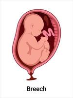 Breech baby in the womb illustration vector